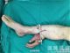 断手寄养在小腿 神奇医术成功回植机器绞断手臂