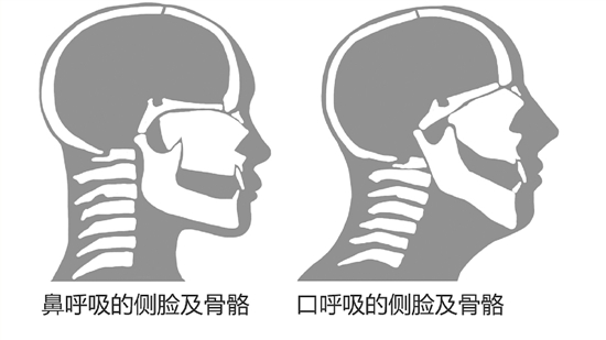 用嘴呼吸会造成面部骨骼的变形，当心从左面的正常脸变成右面的“腺样体面容”。林炎挺 制图