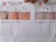 呼市幼儿园孩子身上发现针眼 3名老师被刑拘