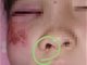 陕西一学生算错题遭老师殴打 砸伤眼部险失明