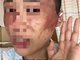 女子因不想生二胎被丈夫泼硫酸 丈夫仅行拘10天