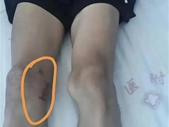 17岁体育生左腿长瘤右腿挨刀 广西右江一医院6人被处理